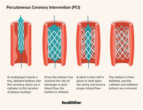 pci types|types of percutaneous coronary intervention.